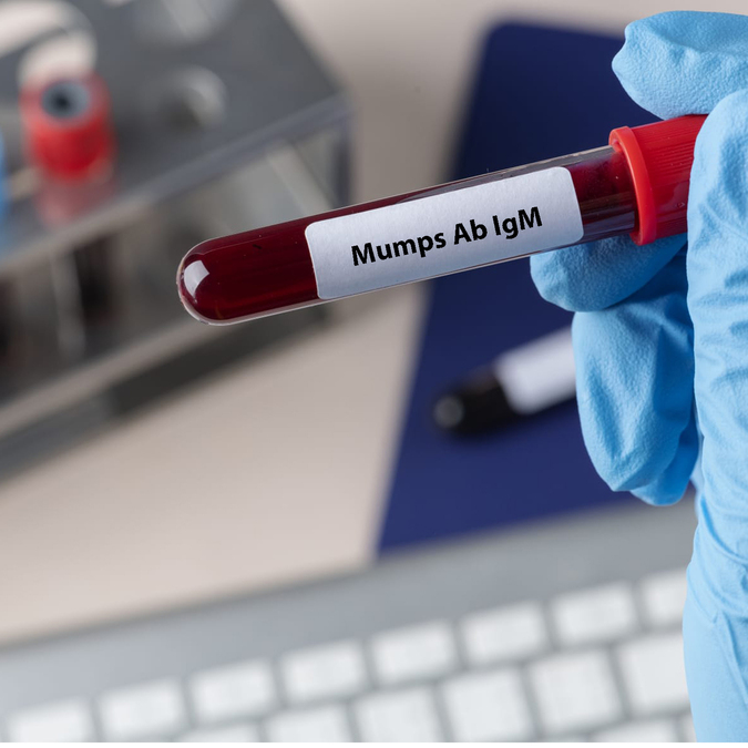 Mumps Ab IgM ( Kabakulak )